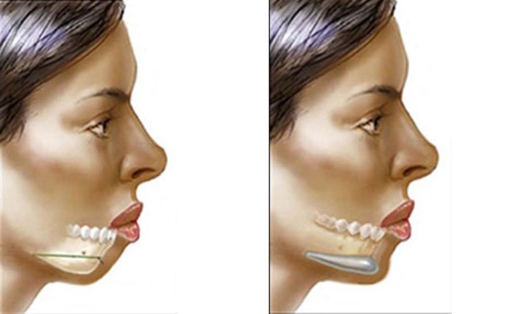 Chin Surgery